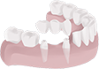 illustration showing dental bridge being applied to lower jaw with anchors
