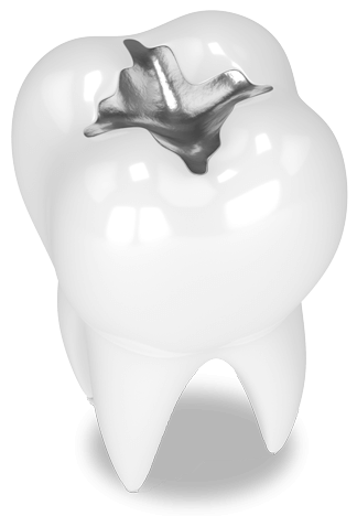 Illustration showing a molar with a filling